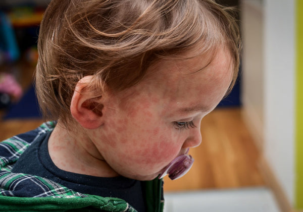 Image of child with roseola