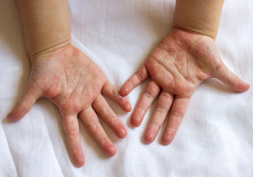 Scarlet fever rash on hands