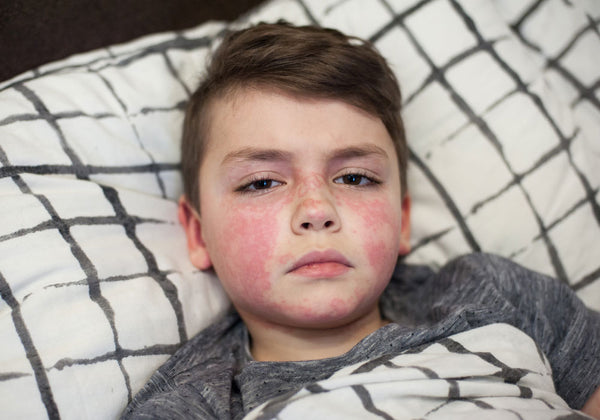 Image of child with scarlet fever