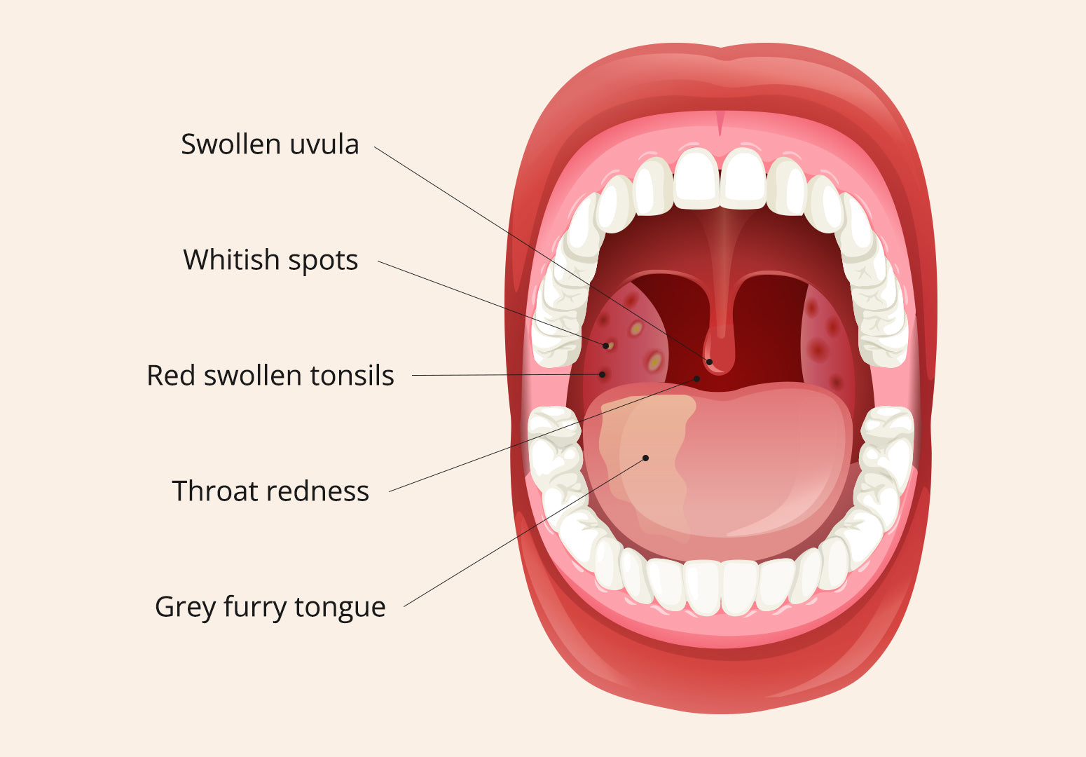 Illustration of a mouth showing what tonsillitis looks like