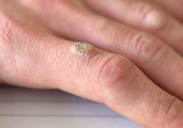 Image of a wart on a man's hand