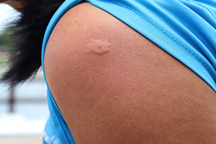 Image of a wasp sting on top of arm