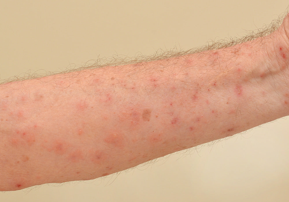 Image of a scabies rash on man's arm