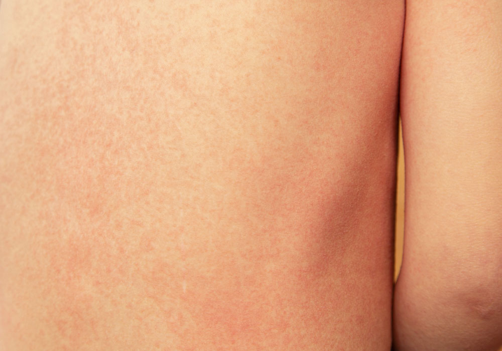 Learn More About Scarlet Fever And How To Protect Your Children - Health  Beat