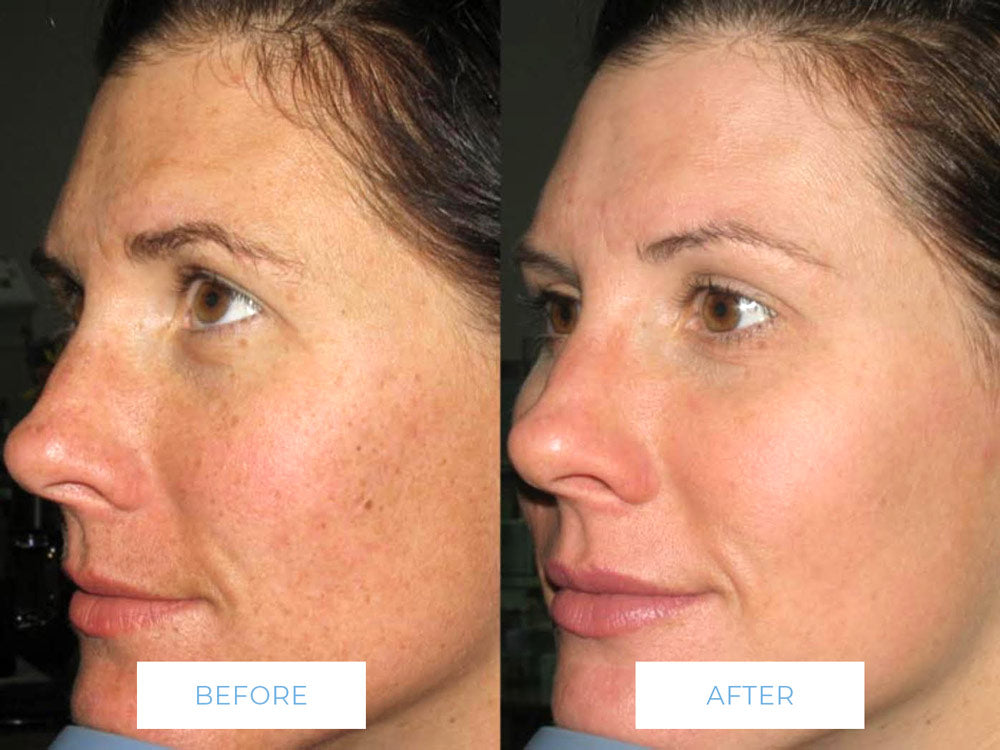 Ultimate Glow Facial before and after