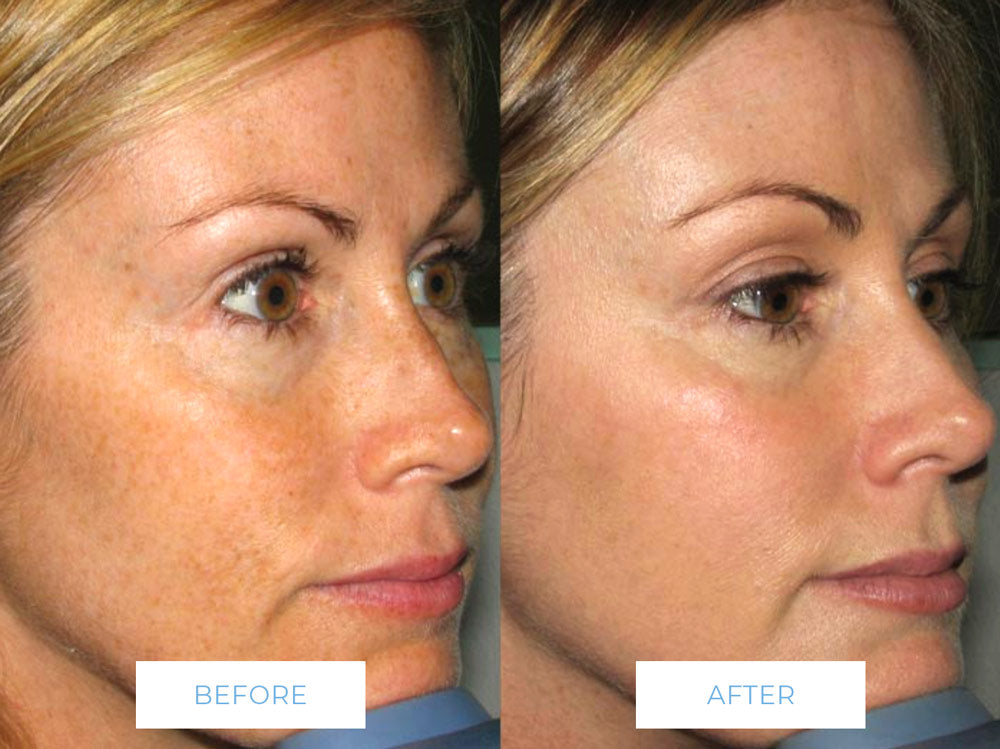 Before and After Ultimate Glow Facial