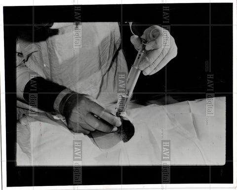 1976 Press Photo amniocentesis - Historic Images