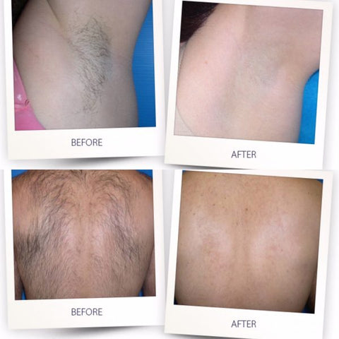 benefits of IPL hair removal