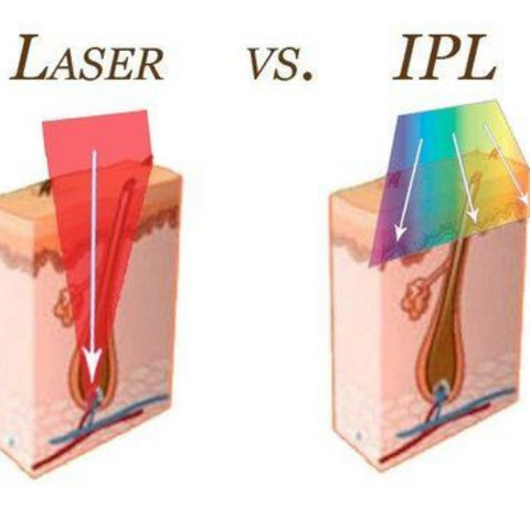 Laser vs IPL