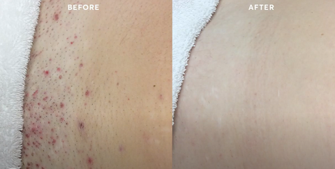 What should I expect after my first Brazilian laser hair removal
