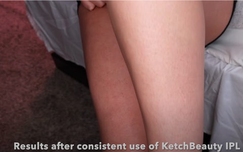 at home laser hair removal before and after results with ketchbeauty ipl