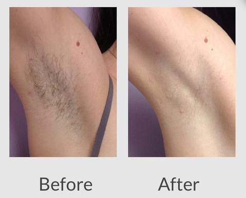 at home laser hair removal results 