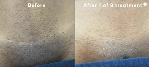 my first Brazilian laser hair removal