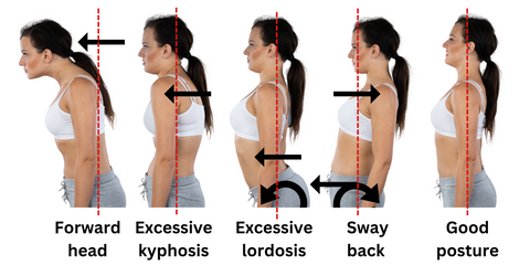 Postural and muscular imbalances image sway back, excessive lordosis, lumbar spine, thoracic spine, excessive kyphosis, hyperlordosis, forward head carriage, good posture, anterior pelvic tilt, posterior pelvic tilt