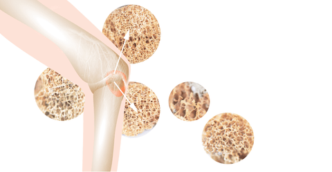 Dr Kez ChiroLab Osteoporosis Osteopenia