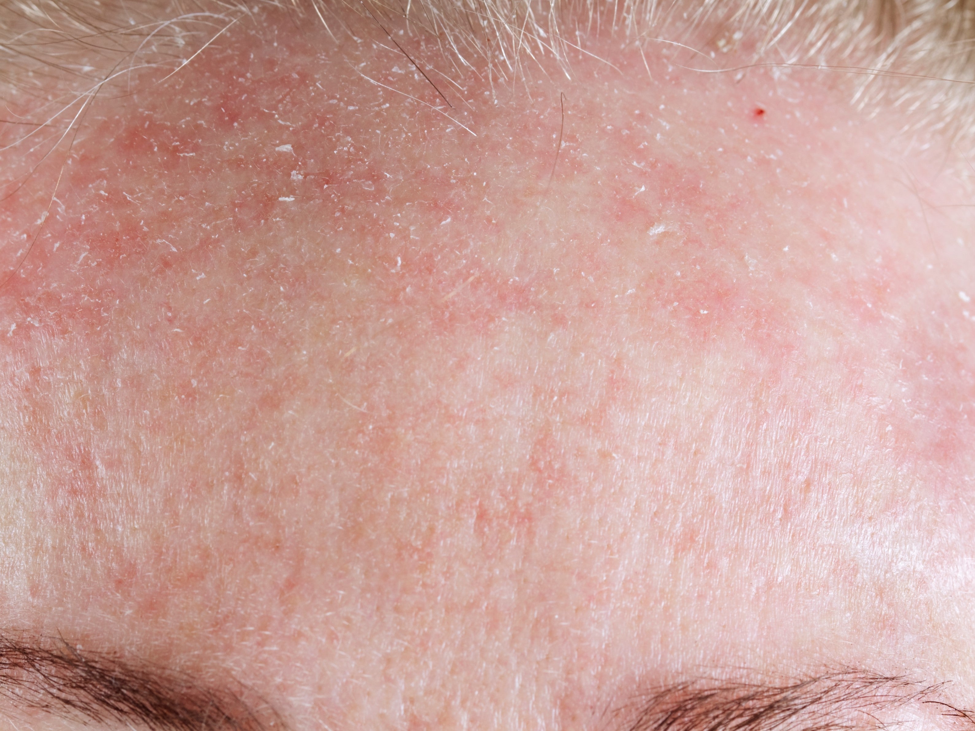 rosacea and demodex causing flaking red facial skin