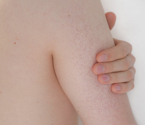 keratosis pilaris on the arms