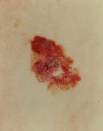 melanoma skin cancer image