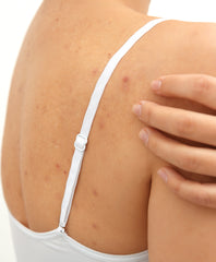 Pityrosporum folliculitis acne on the back