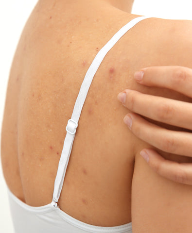 back and chest acne in summer treatment tips