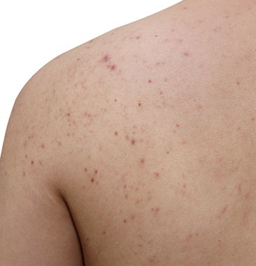 Pityrosporum folliculitis of the back