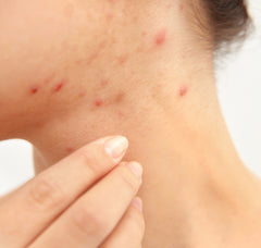 pityrosporum folliculitis of the jaw and neck