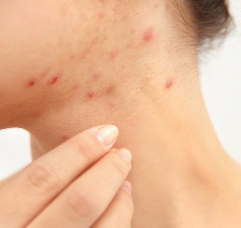 sweat acne neck pimples causes from Pityrosporum folliculitis