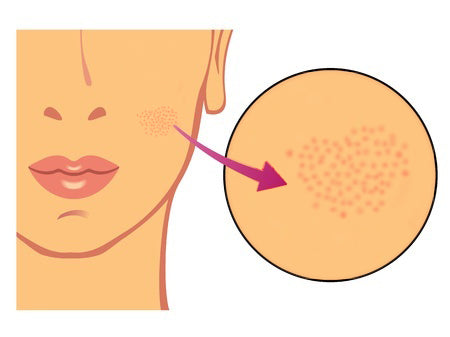 Signs of Rosacea sebaceous hyperplasia papules