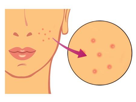 Rosacea signs pimples