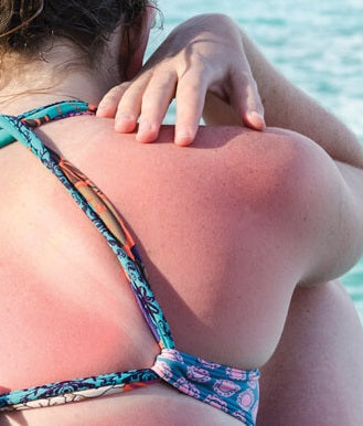 expired sunscreen can lead to sunburn