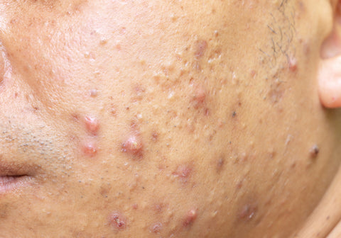 acne vulgaris treatment tips dermatologist's