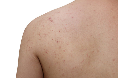 back and chest acne Pityrosporum folliculitis treatment