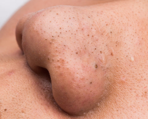 blackheads noninflammatory acne