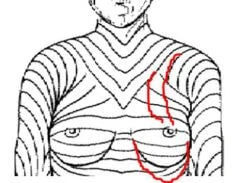 Port scars and placement on the side of the chest in Maximal Skin Tension Lines