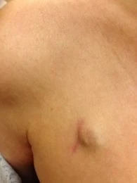 photo of a port scar on the chest