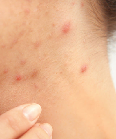dyschromia skin disorder from acne PIH