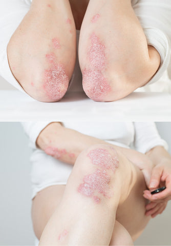 dyschromia and psoriasis