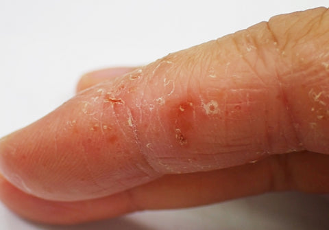 dyshidrotic hand eczema symptoms picture