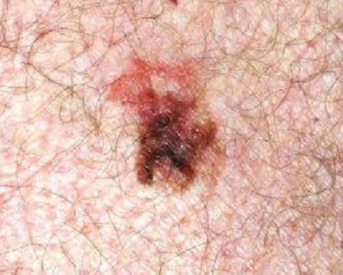 picture of early melanoma