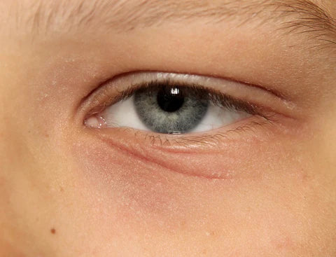 eyelid dermatitis swollen rough scaly 