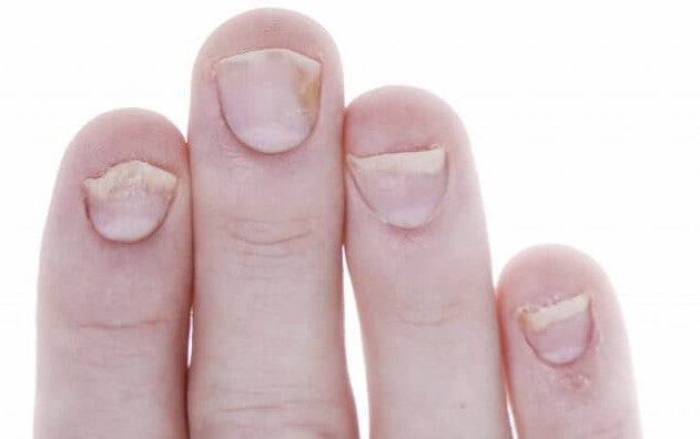 nail psoriasis on fingernails what it looks like