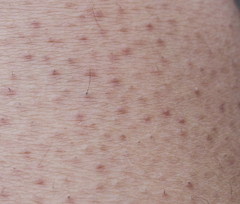 keratosis pilaris on black skin