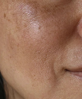 melasma