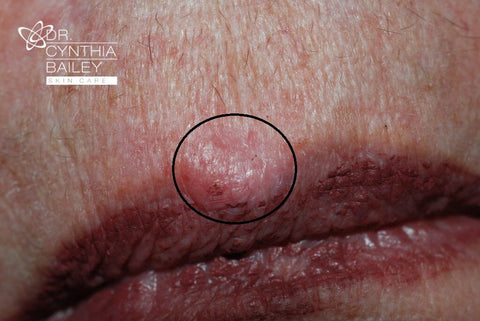 the most common form of skin cancer is basal cell carcinoma