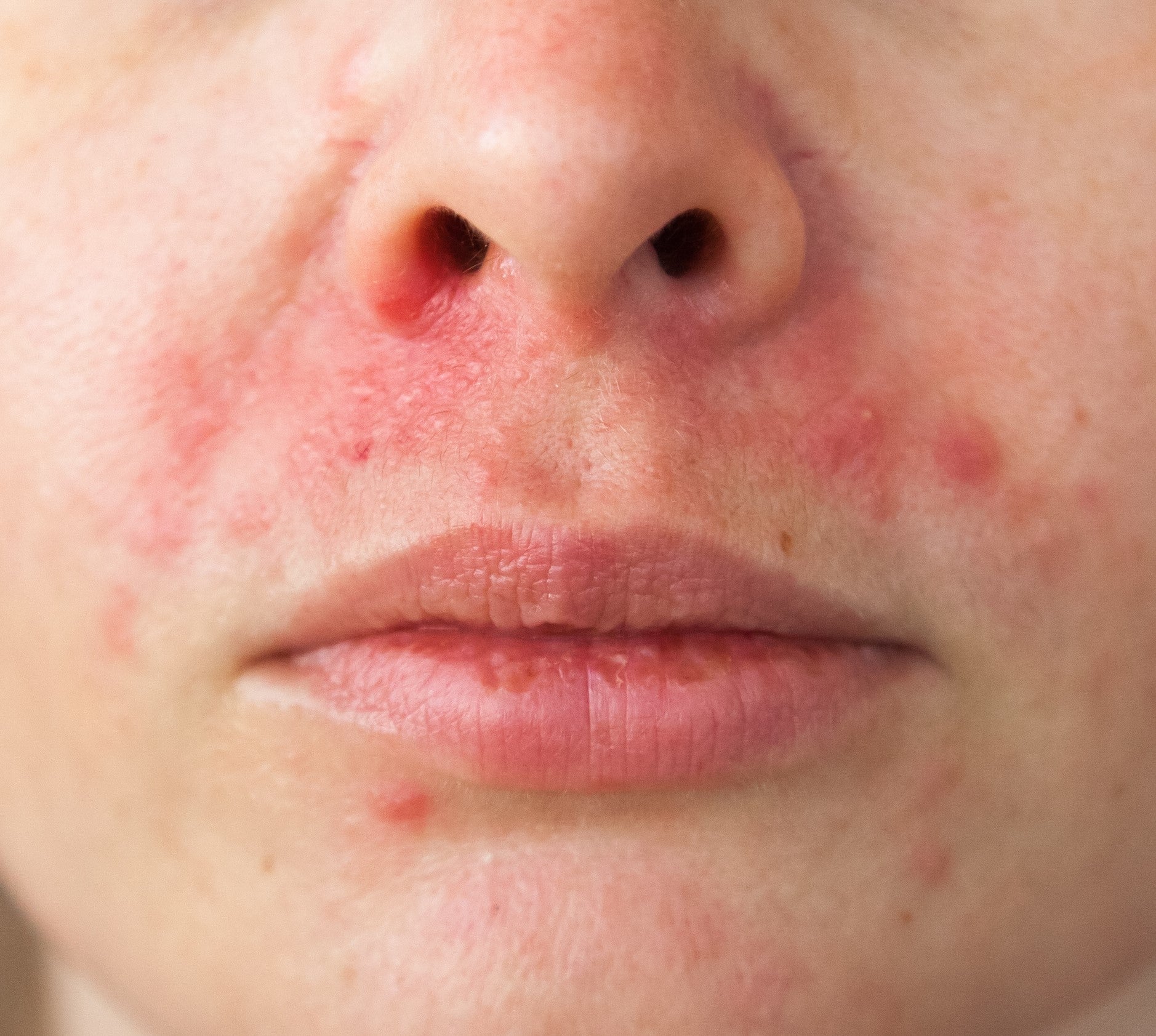 Perioral dermatitis