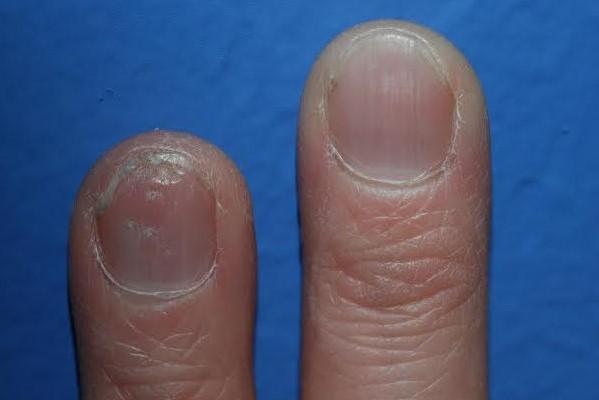 treatment for nail psoriasis image