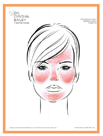 Facial redness from rosacea