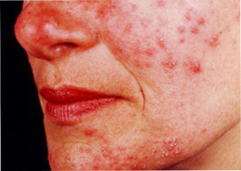 Red facial skin sufferings from papulopustular rosacea.