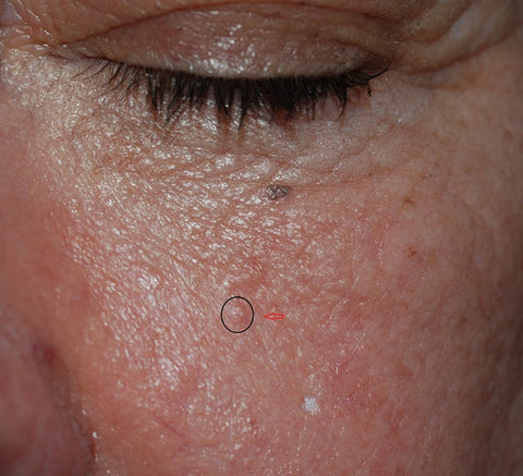 sebaceous hyperplasia papules