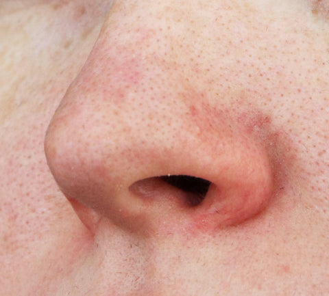 seborrhea of the nose crease